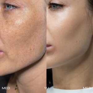 Peelings treatment at MED YU MED Dubai