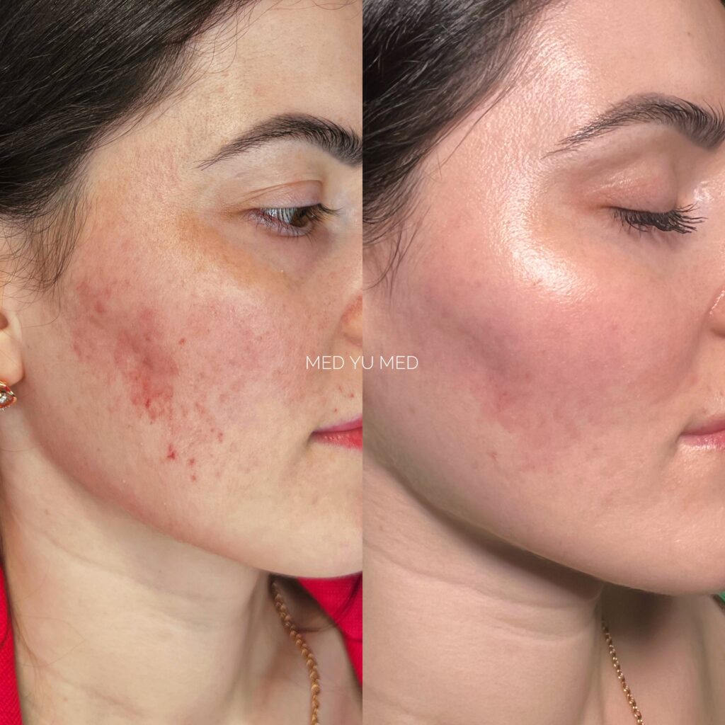 BBL Phototherapy treatment at MED YU MED Dubai