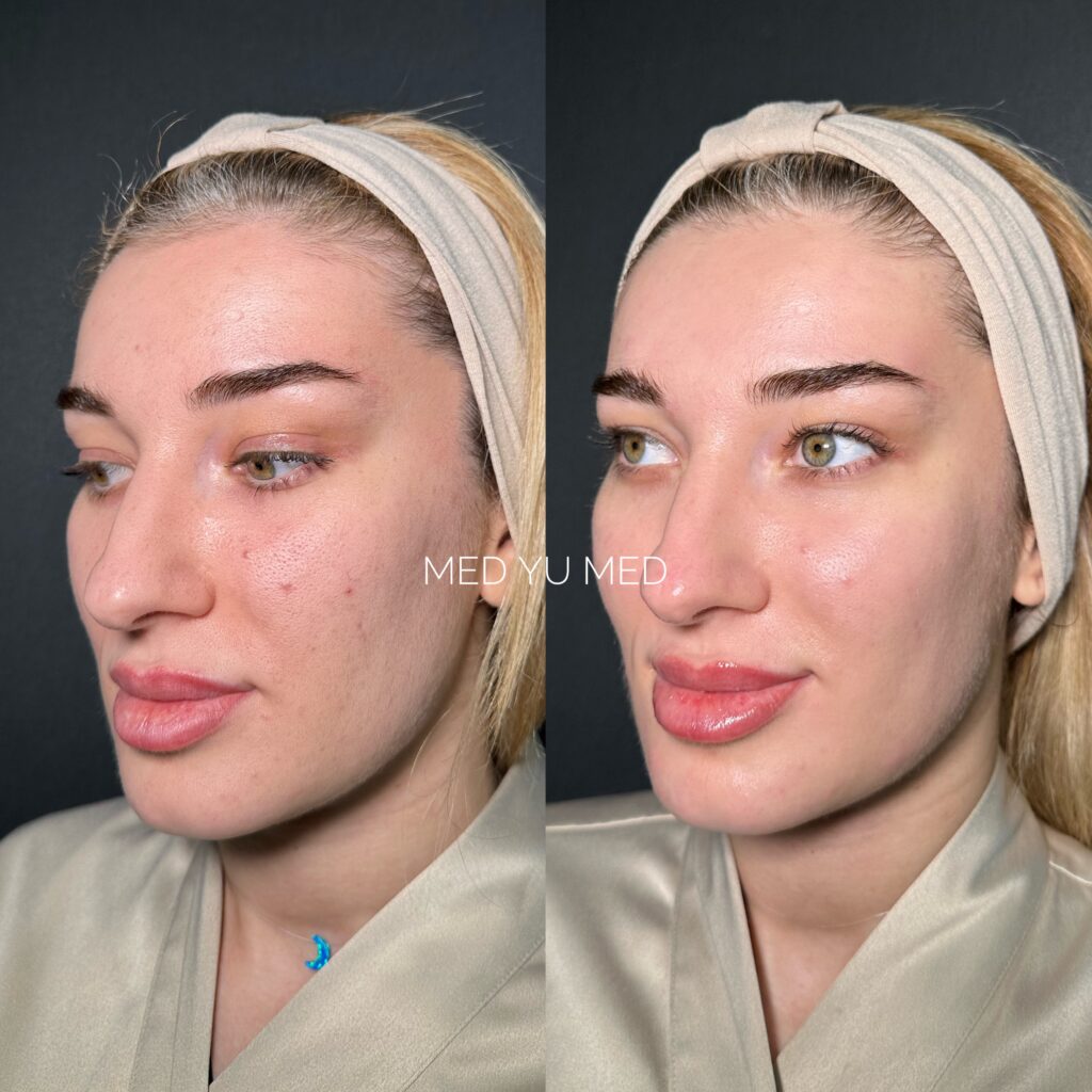 HydraFacial treatment at MED YU MED Dubai