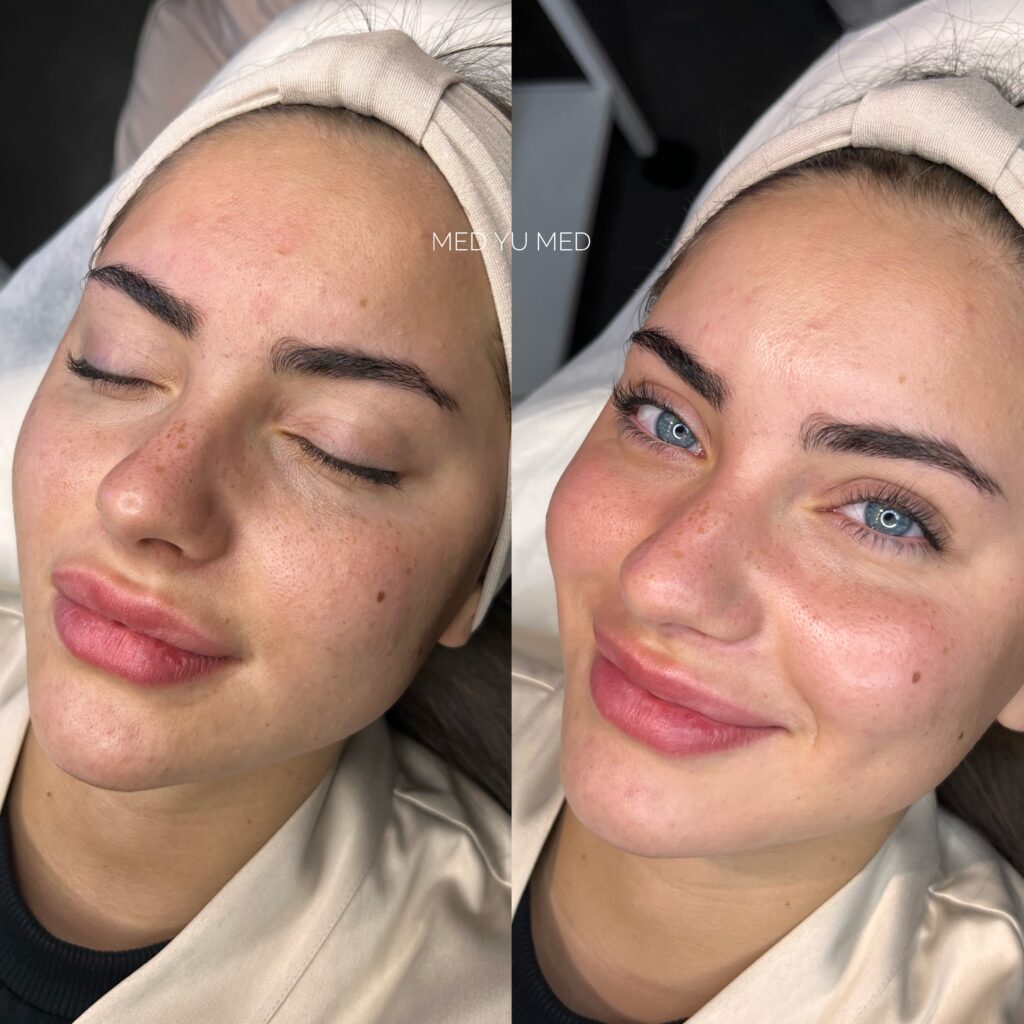 HydraFacial treatment at MED YU MED Dubai