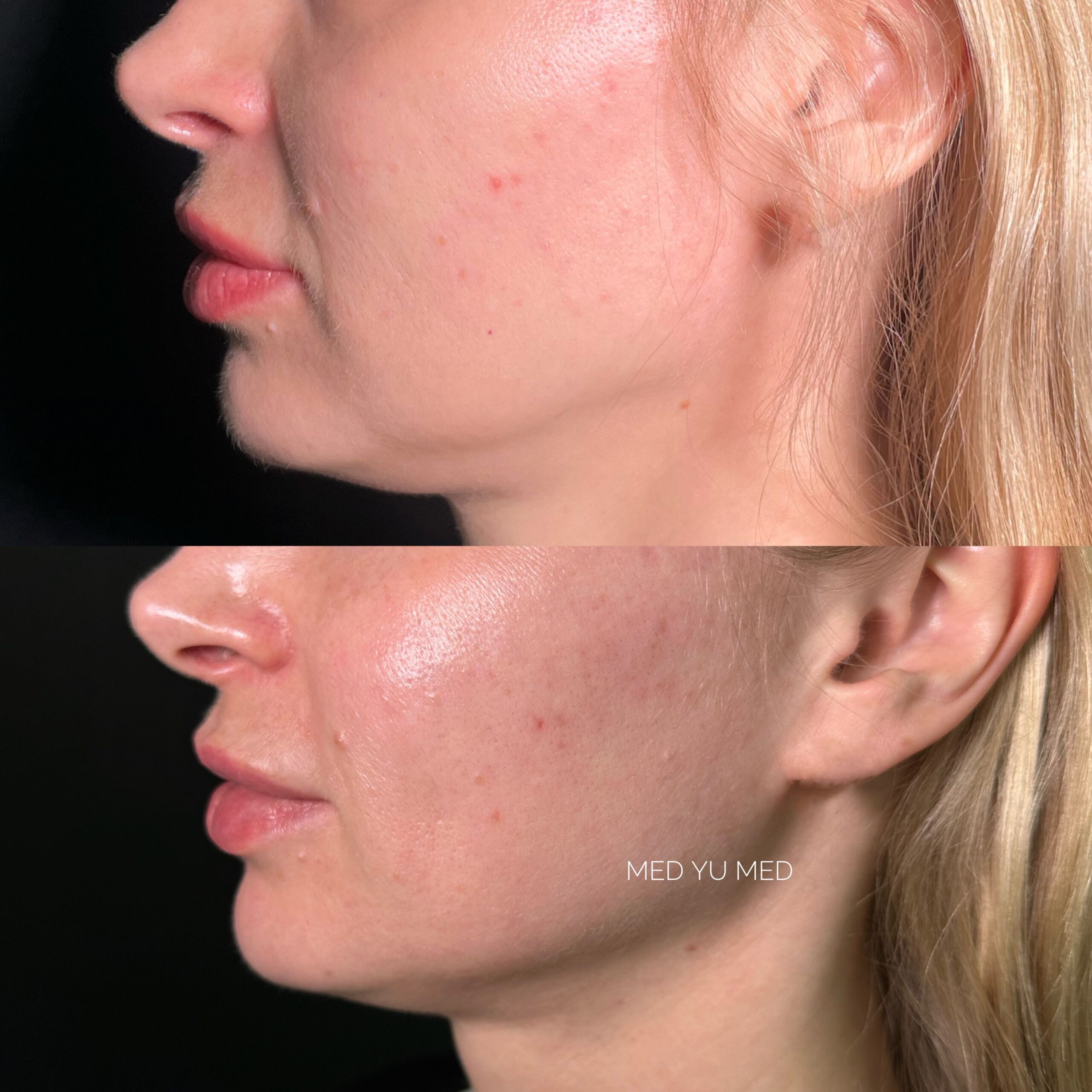 Before and after Morpheus8 RF Microneedling (Morpheus Pro) at MED YU MED Dubai: face in profile, skin texture