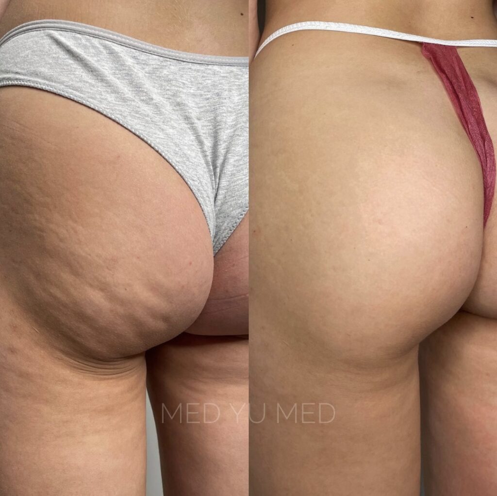 Endospheres Therapy treatment at MED YU MED Dubai