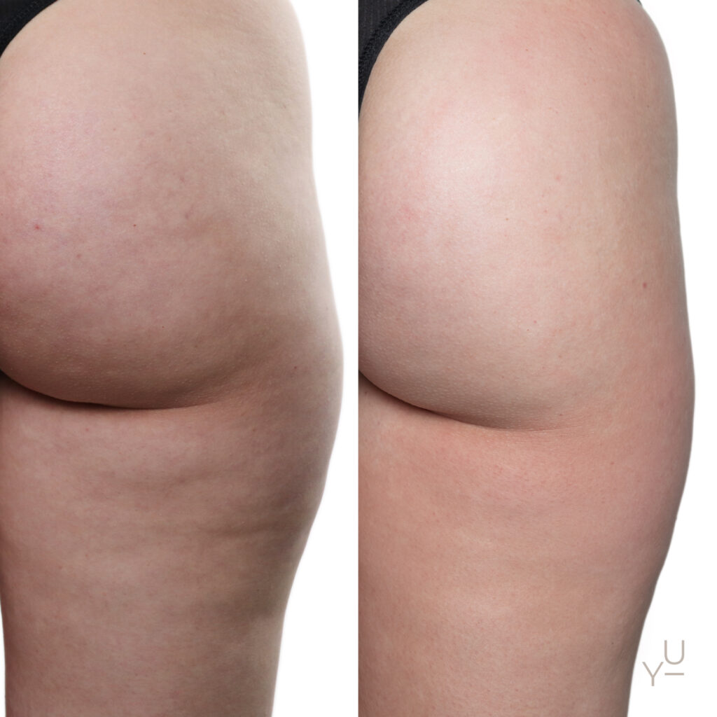 Endospheres Therapy treatment at MED YU MED Dubai