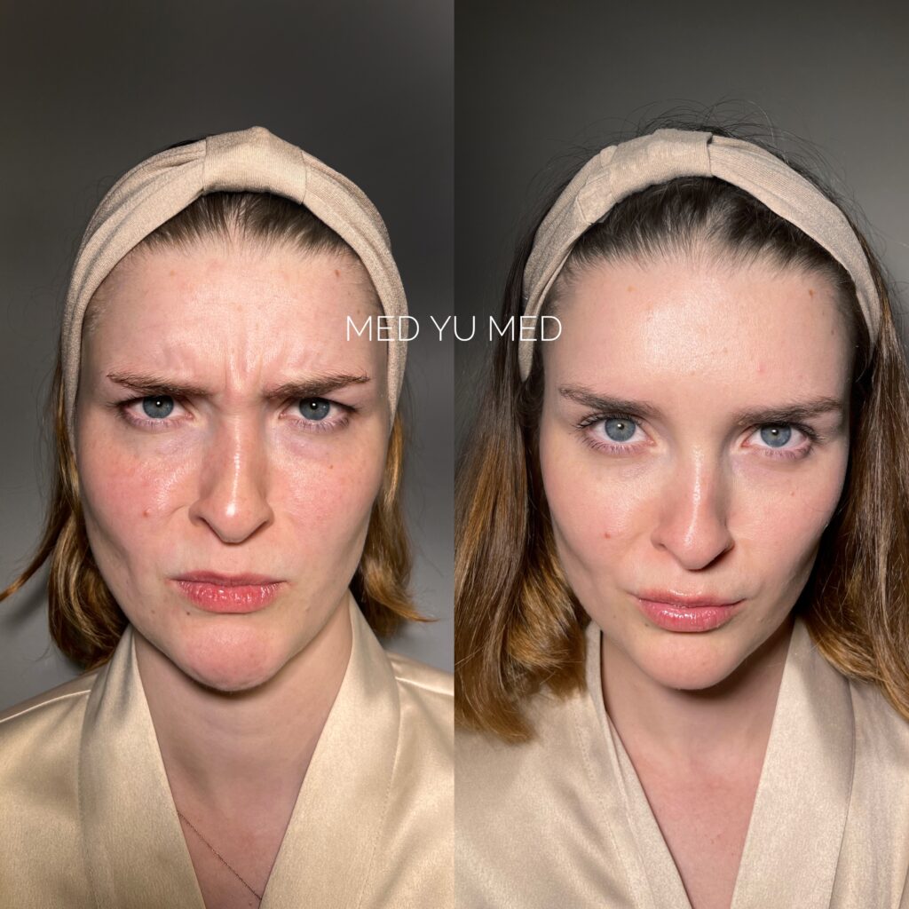 Botulinum therapy treatment at MED YU MED Dubai