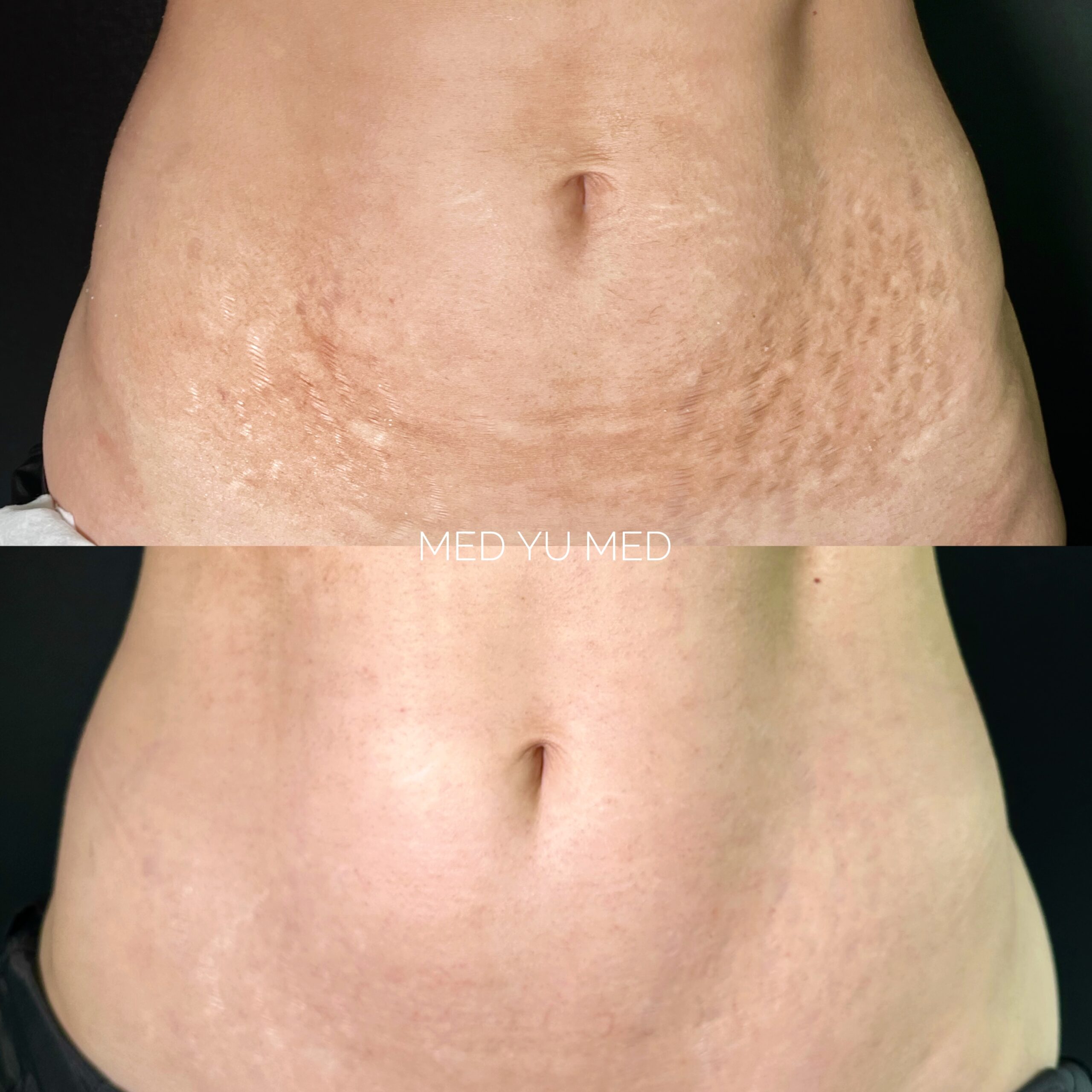 Before and after Morpheus8 RF Microneedling (Morpheus Pro) at MED YU MED Dubai: abdomen, stretch marks