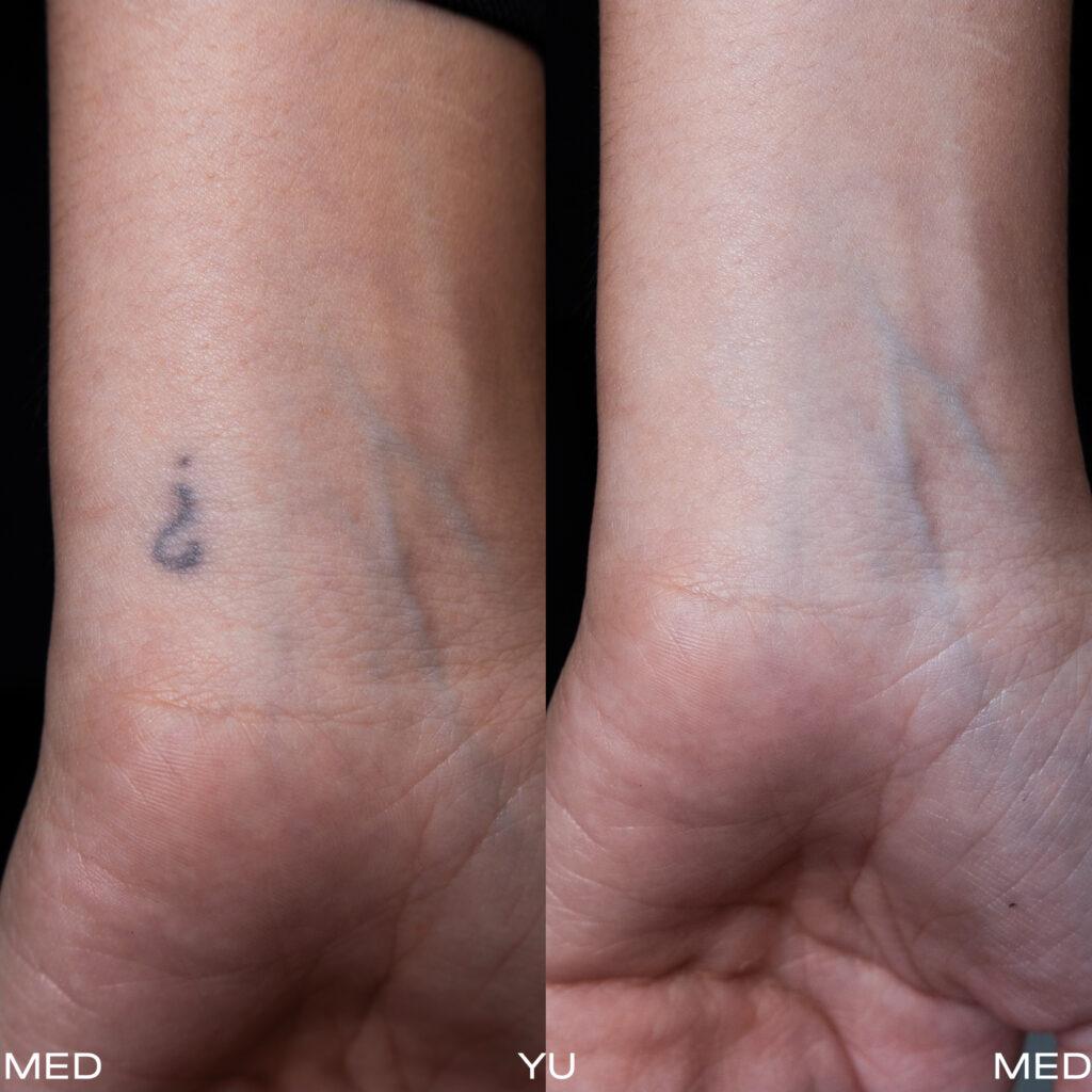 PicoSure Pro treatment at MED YU MED Dubai