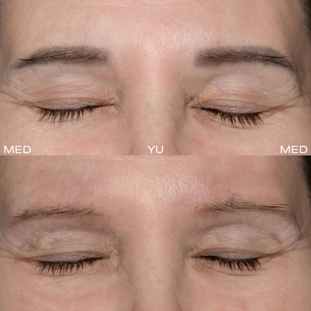 PicoSure Pro treatment at MED YU MED Dubai
