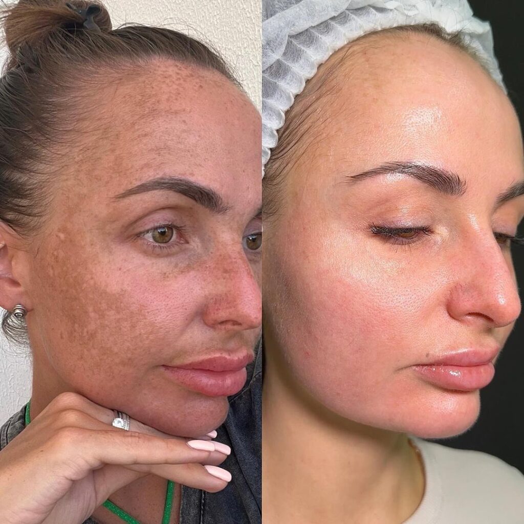 BBL Phototherapy treatment at MED YU MED Dubai