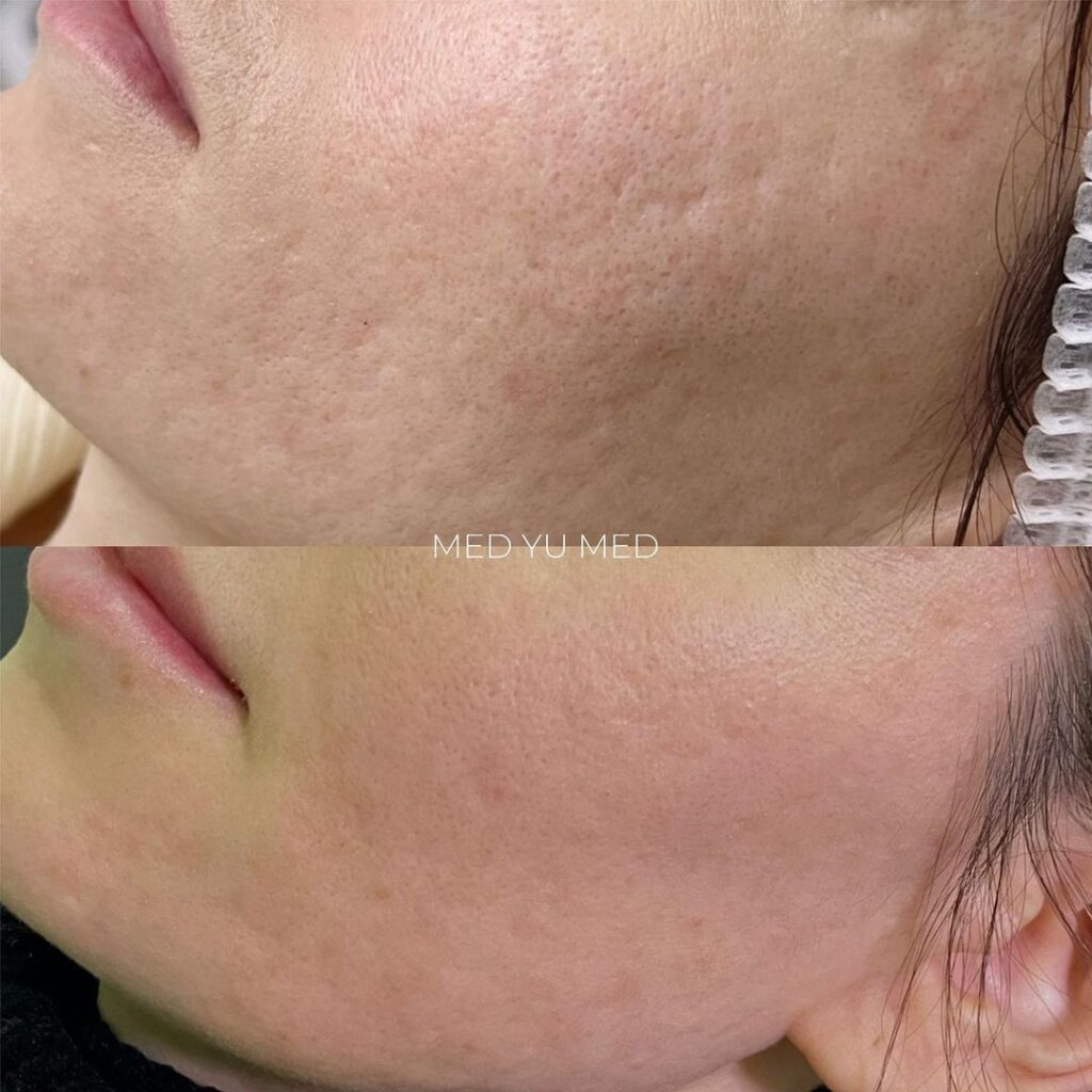 Laser therapy MOXI treatment at MED YU MED Dubai