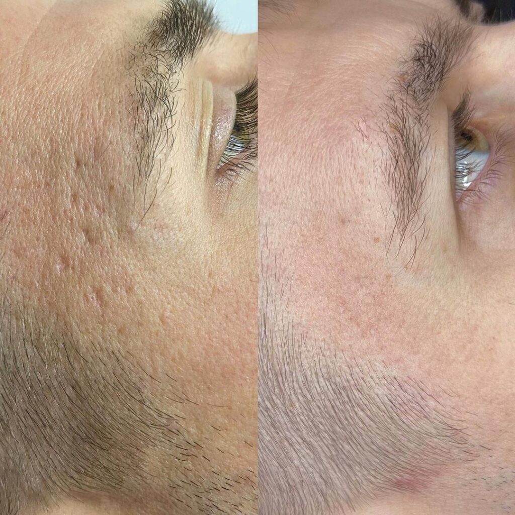 Laser therapy MOXI treatment at MED YU MED Dubai