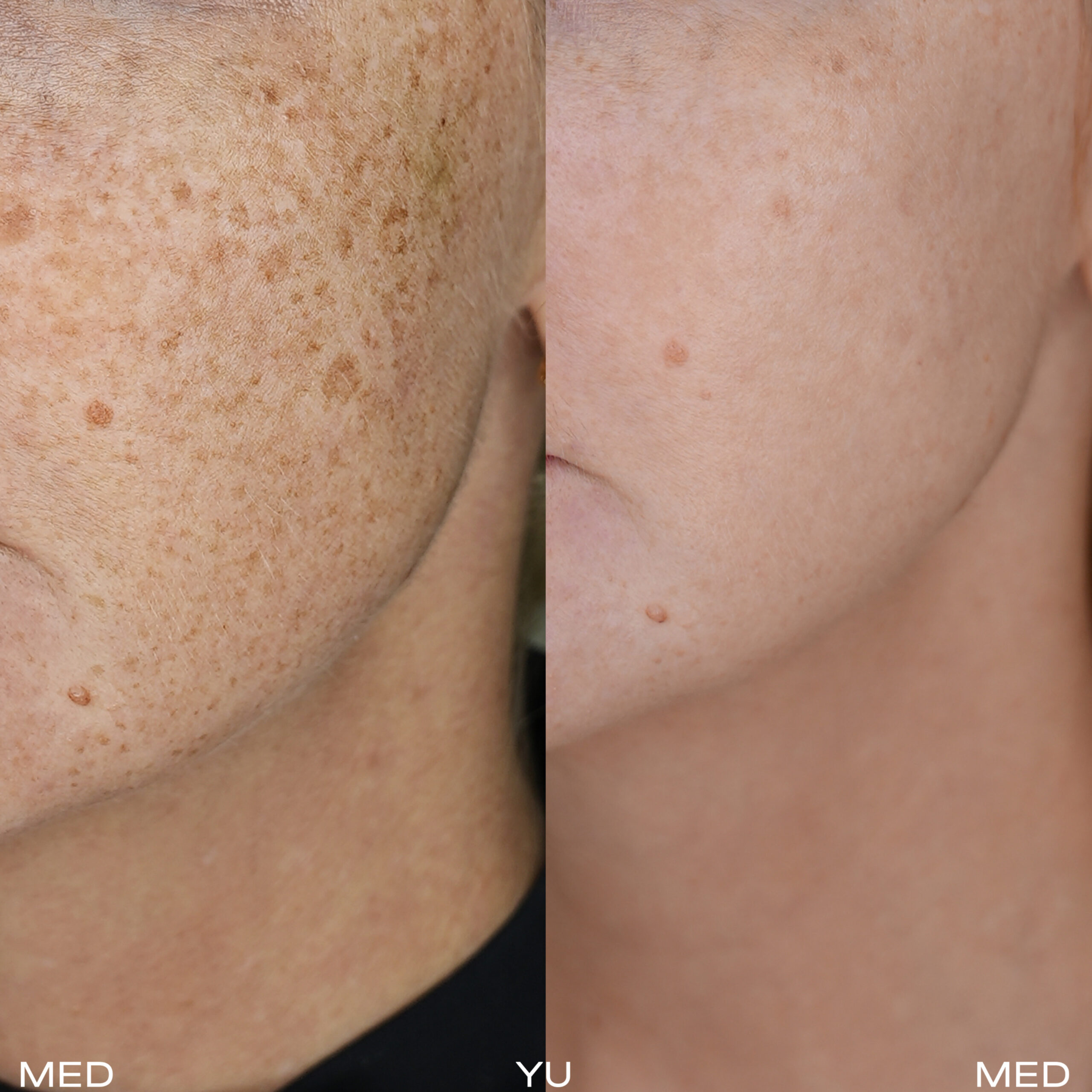Before and after BBL Phototherapy at MED YU MED Dubai: shoulder, pigmentation