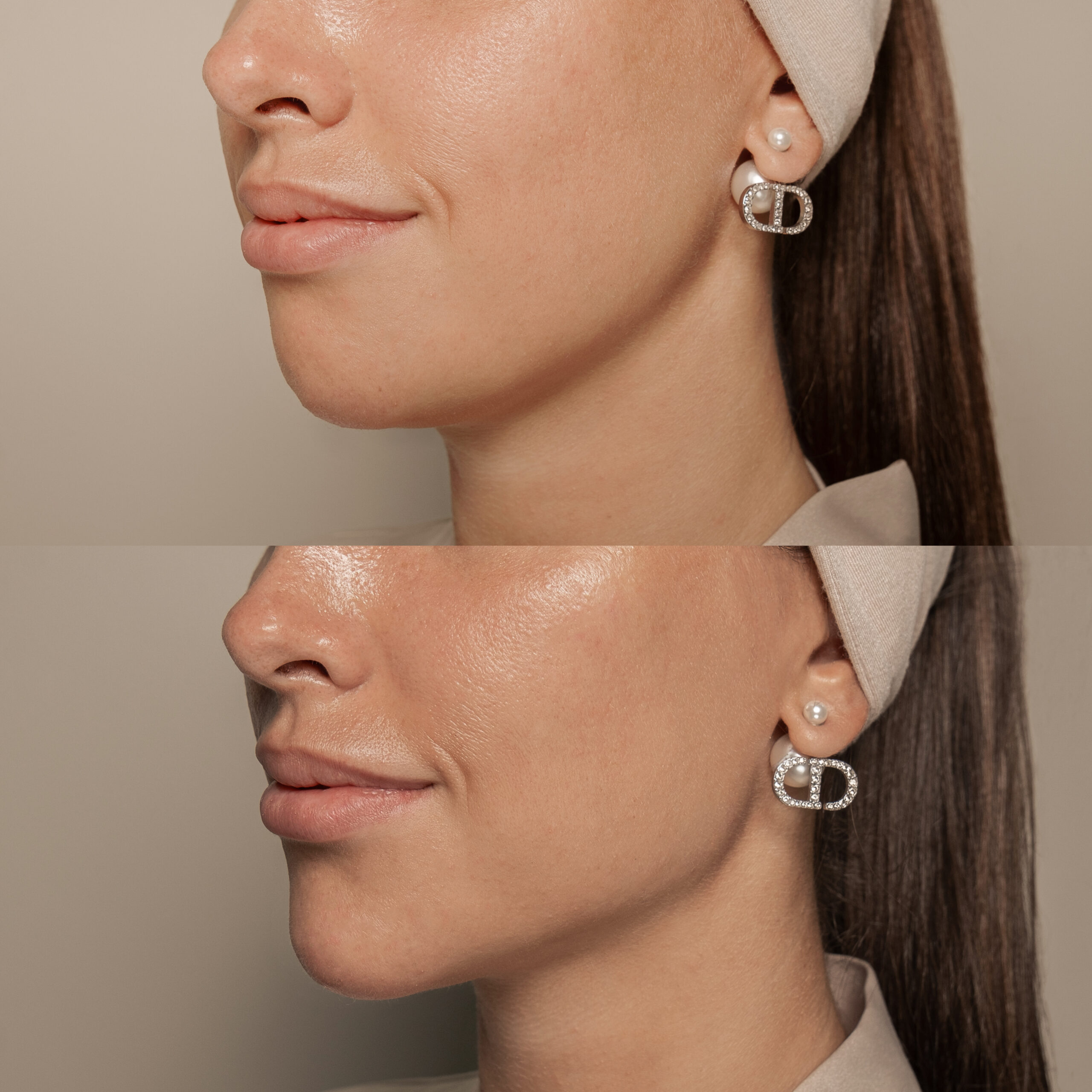 Before and after Face Contouring at MED YU MED Dubai: profile, lower third of the face, one session