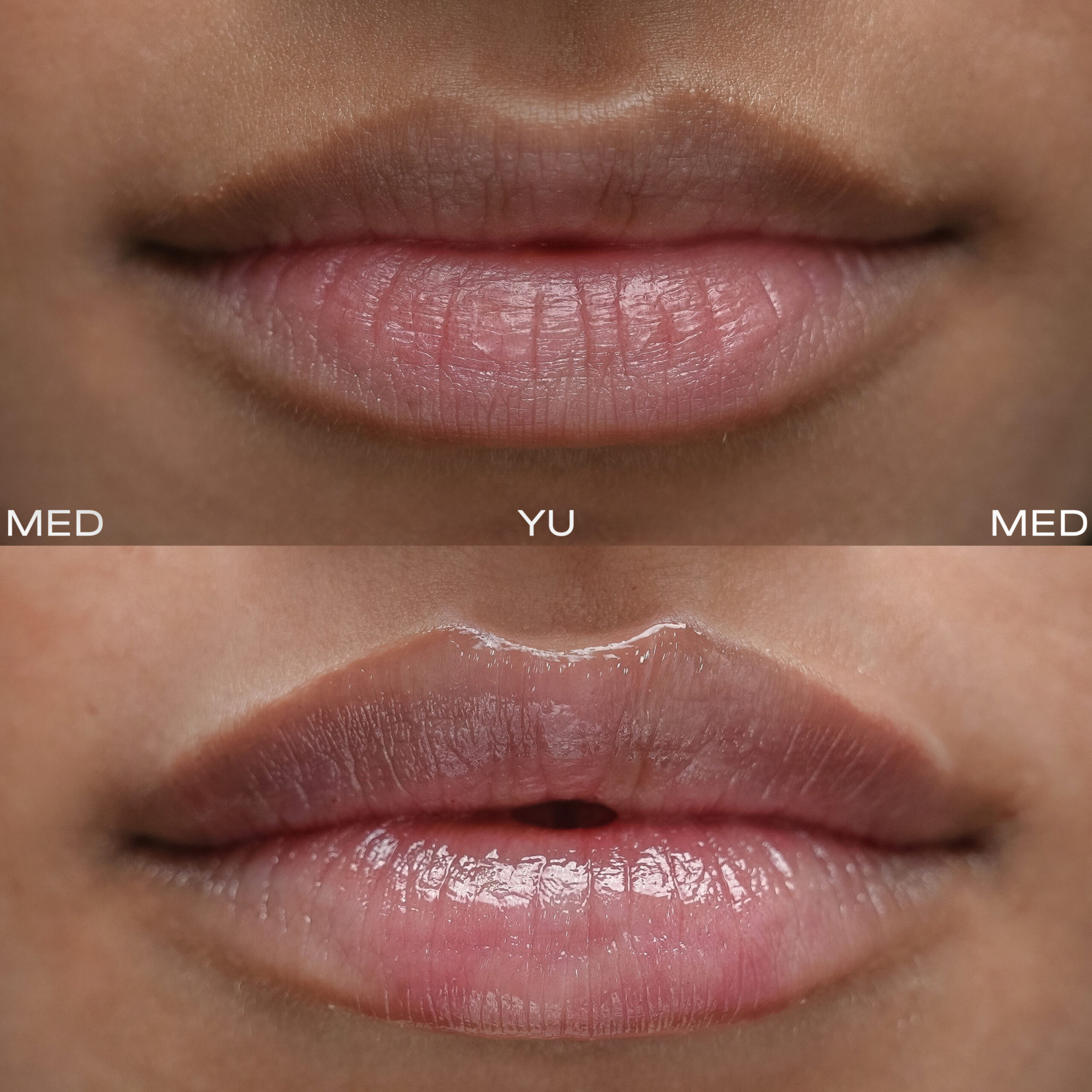 Before and after Lip Augmentation at MED YU MED Dubai: lips, one session