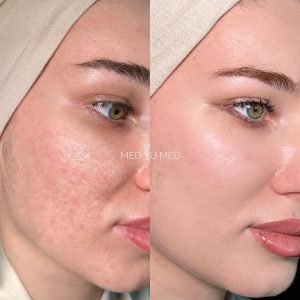 Before and after at MED YU MED Dubai: face, acne