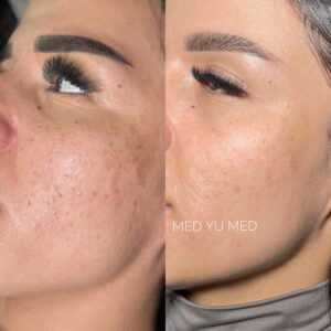 Before and after VIVACE RF Microneedling at MED YU MED Dubai: face, acne