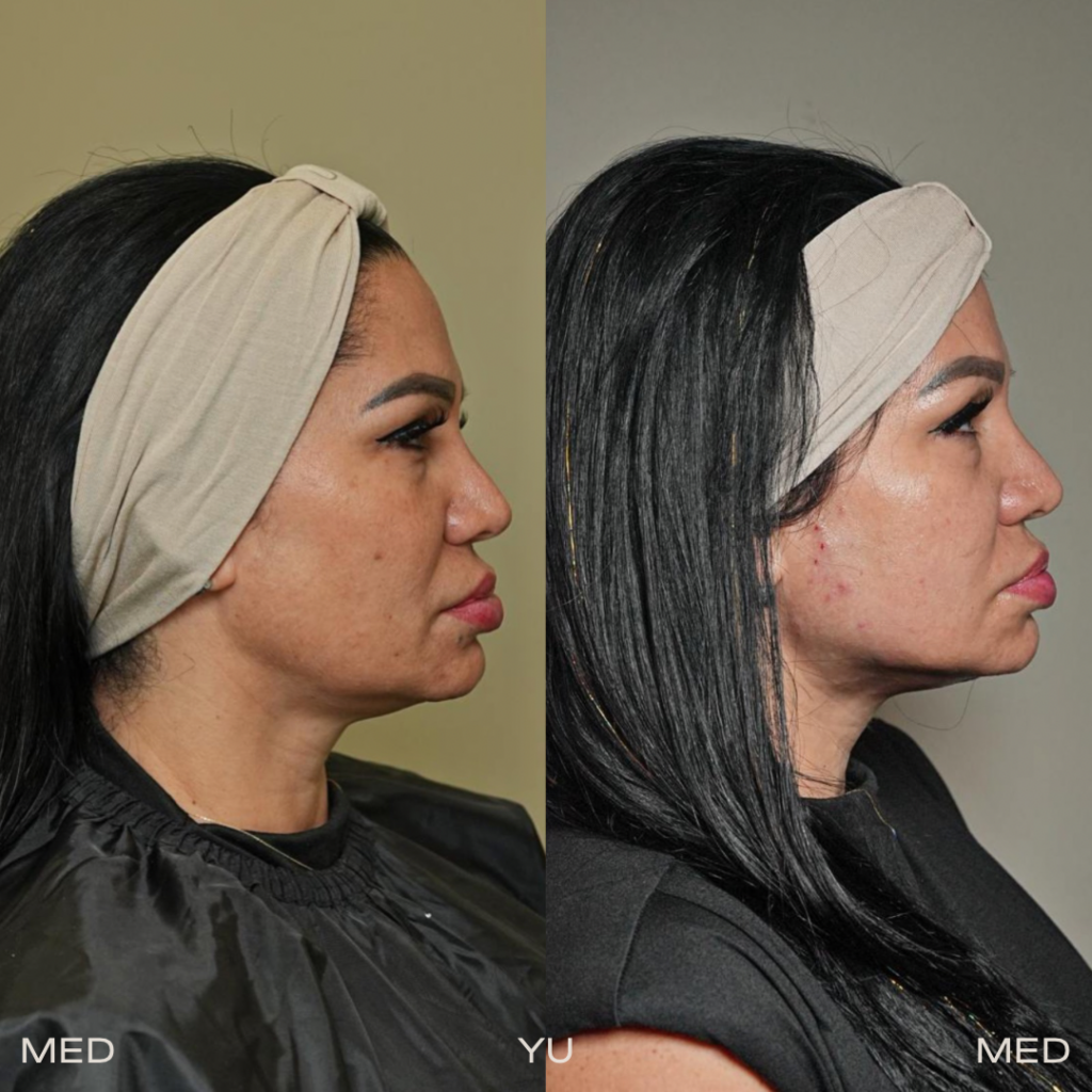 Before and after at MED YU MED Dubai: face in profile