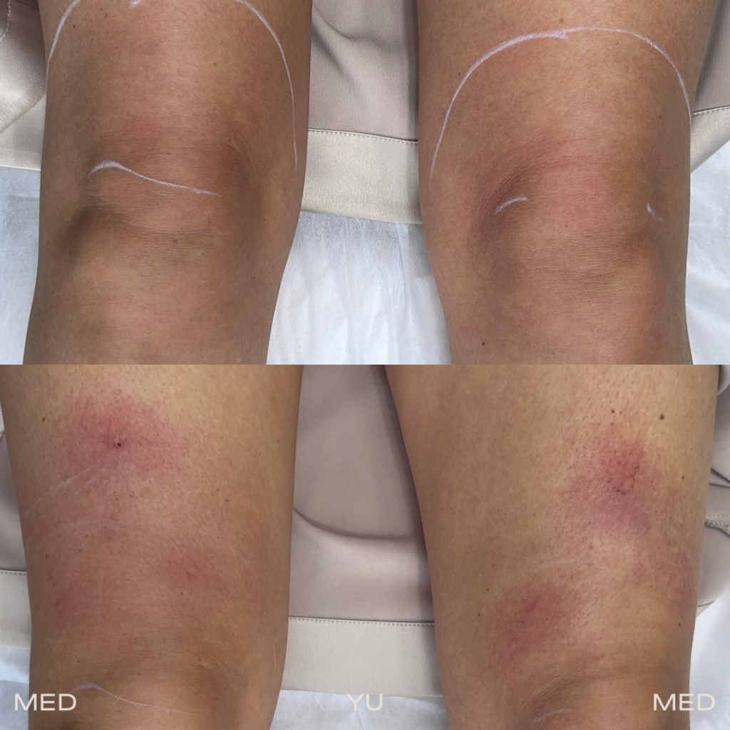 Before and after at MED YU MED Dubai: knees and legs