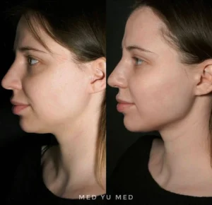 SMAS - lifting (Ultraformer MPT) treatment at MED YU MED Dubai