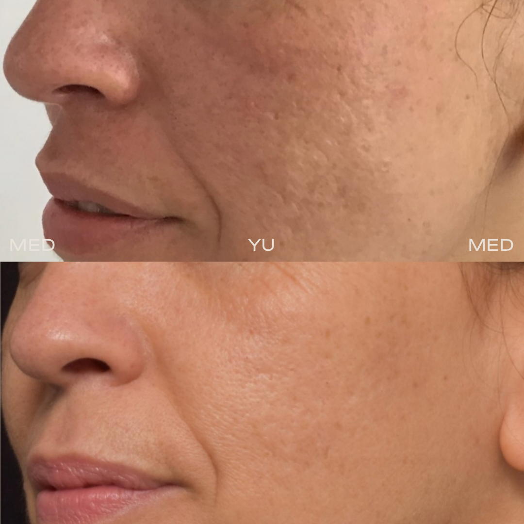 Before and after at MED YU MED Dubai: face, nasolabial folds