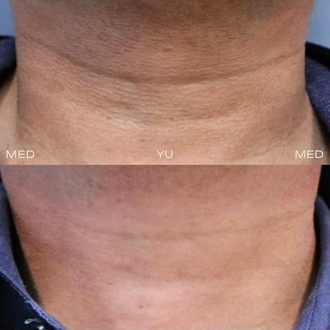 Before and after at MED YU MED Dubai: neck