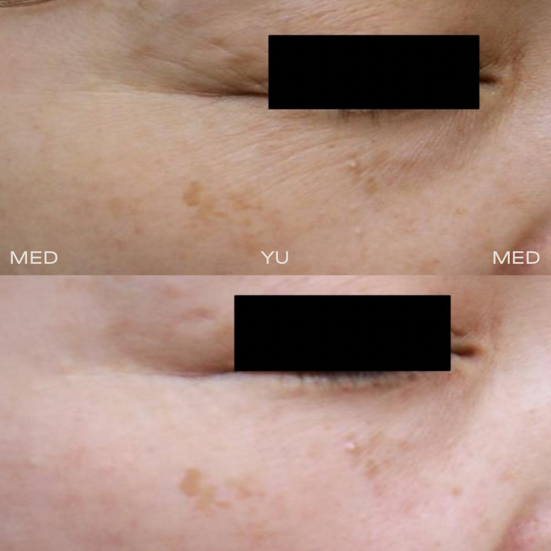 Before and after at MED YU MED Dubai: chest and décolleté