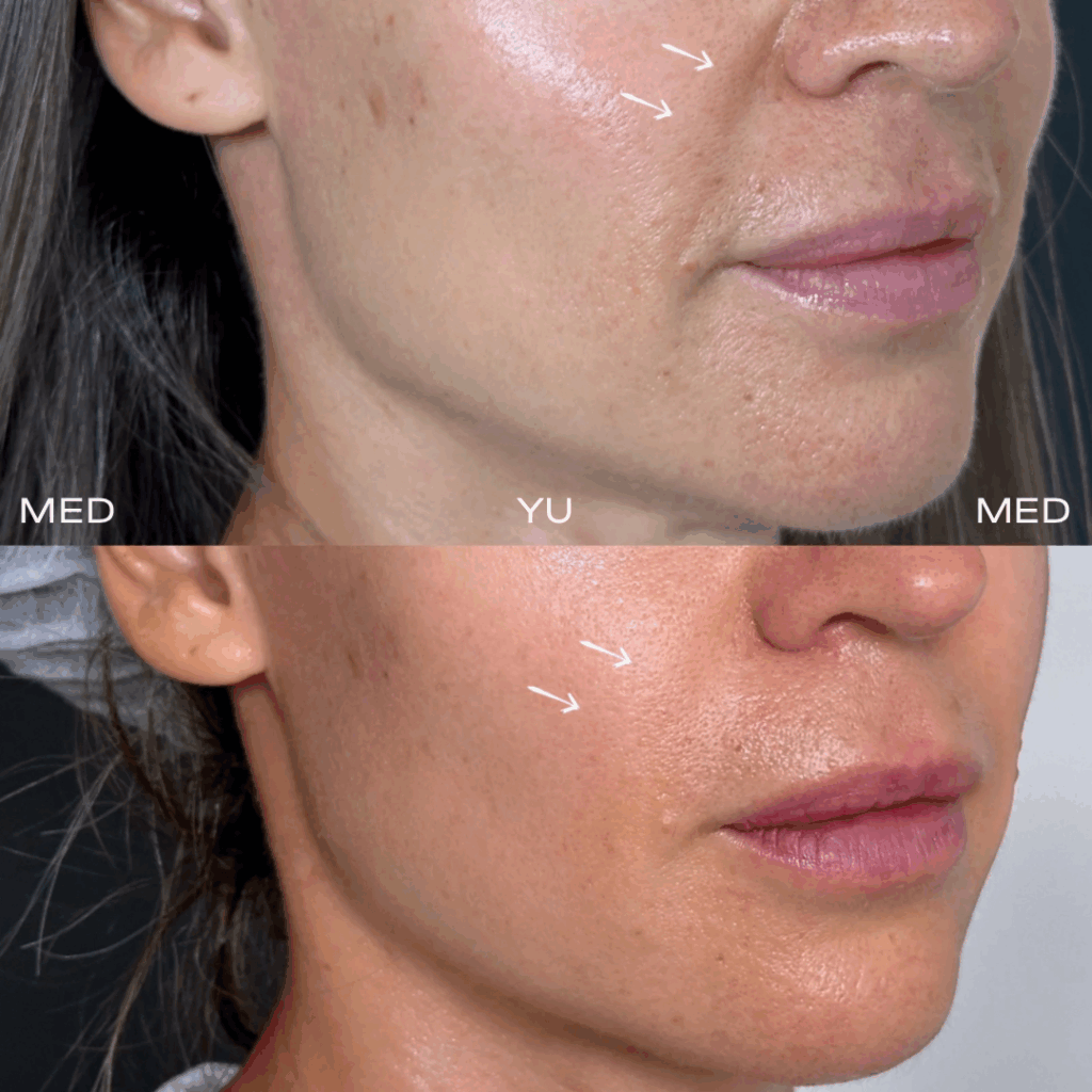 Before and after at MED YU MED Dubai: face, nasolabial folds