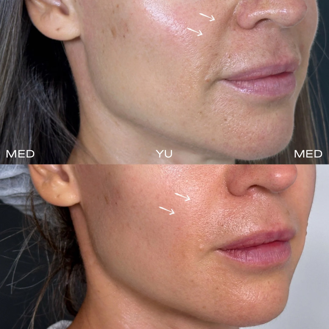 Before and after at MED YU MED Dubai: face, nasolabial folds