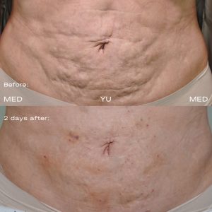 Before and after Endolift Laser Lifting at MED YU MED Dubai: abdomen, stretch marks, two days after one session