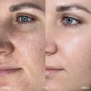 Before and after Genius RF Microneedling (Lutronic) at MED YU MED Dubai: cheek, skin texture