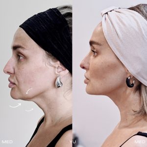 Before and after Endolift Laser Lifting at MED YU MED Dubai: jawline and neck, one session