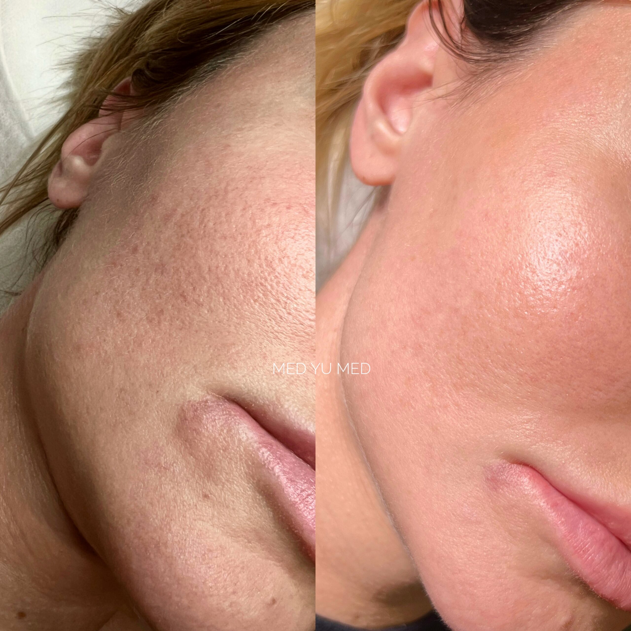Before and after BBL Phototherapy at MED YU MED Dubai: cheek, skin texture