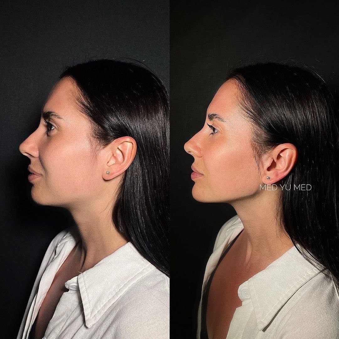 Before and after Face Contouring at MED YU MED Dubai: profile, chin, one session