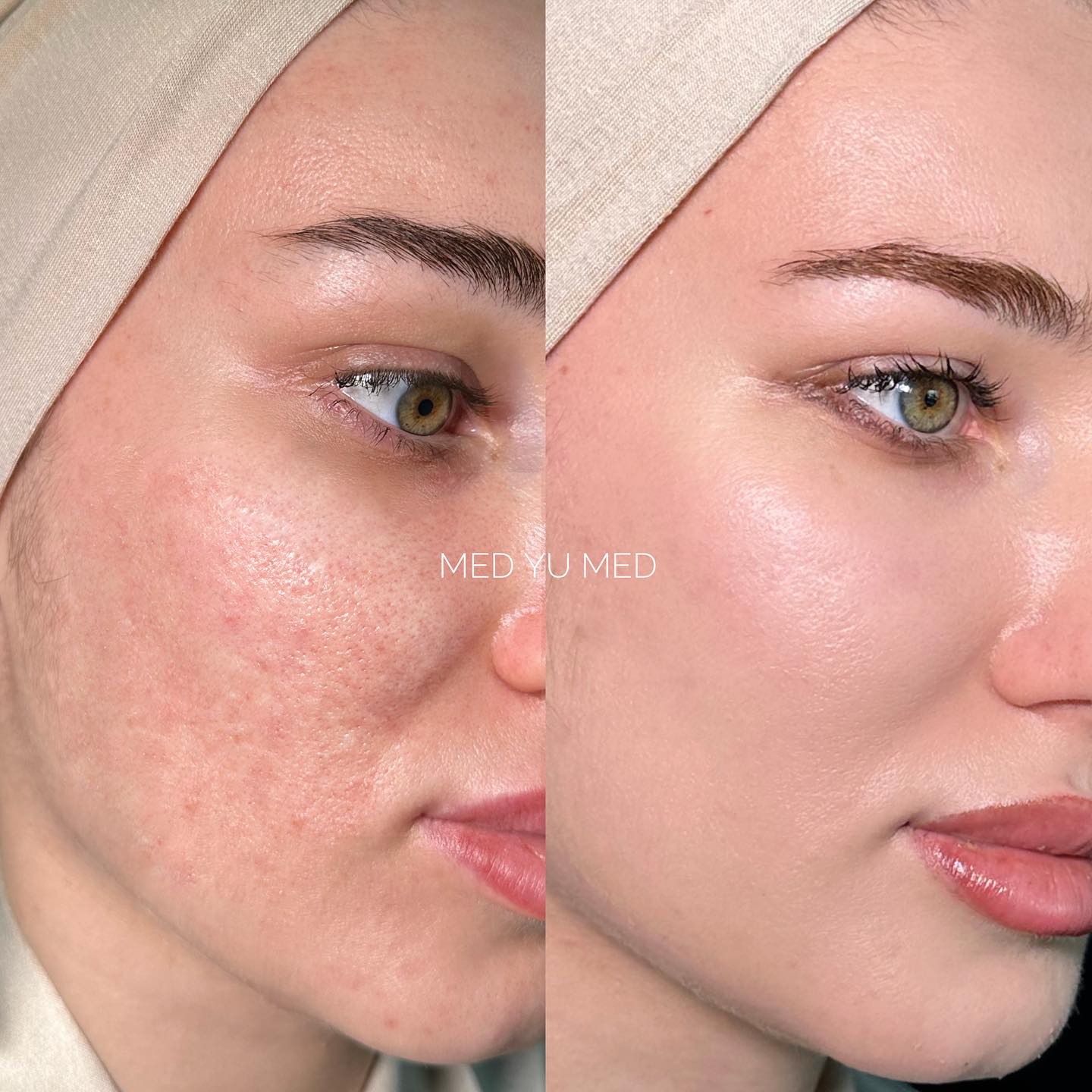 Before and after Morpheus8 RF Microneedling (Morpheus Pro) at MED YU MED Dubai: face, acne scarring