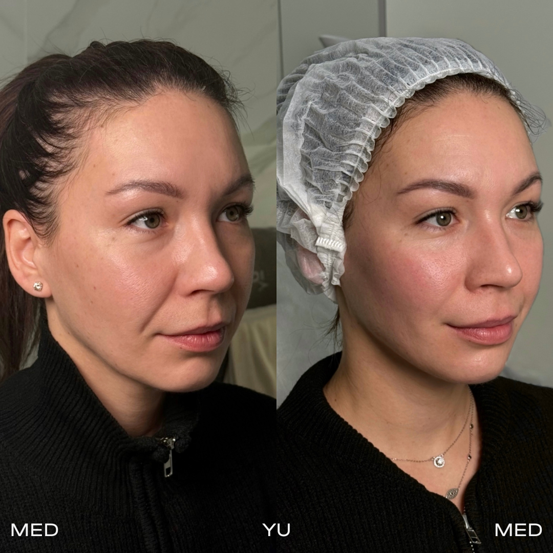 Before and after VOLNEWMER Monopolar RF Lifting at MED YU MED Dubai: face, one session