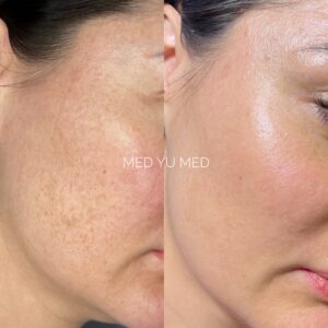 Before and after BBL Phototherapy at MED YU MED Dubai: cheek, pigmentation