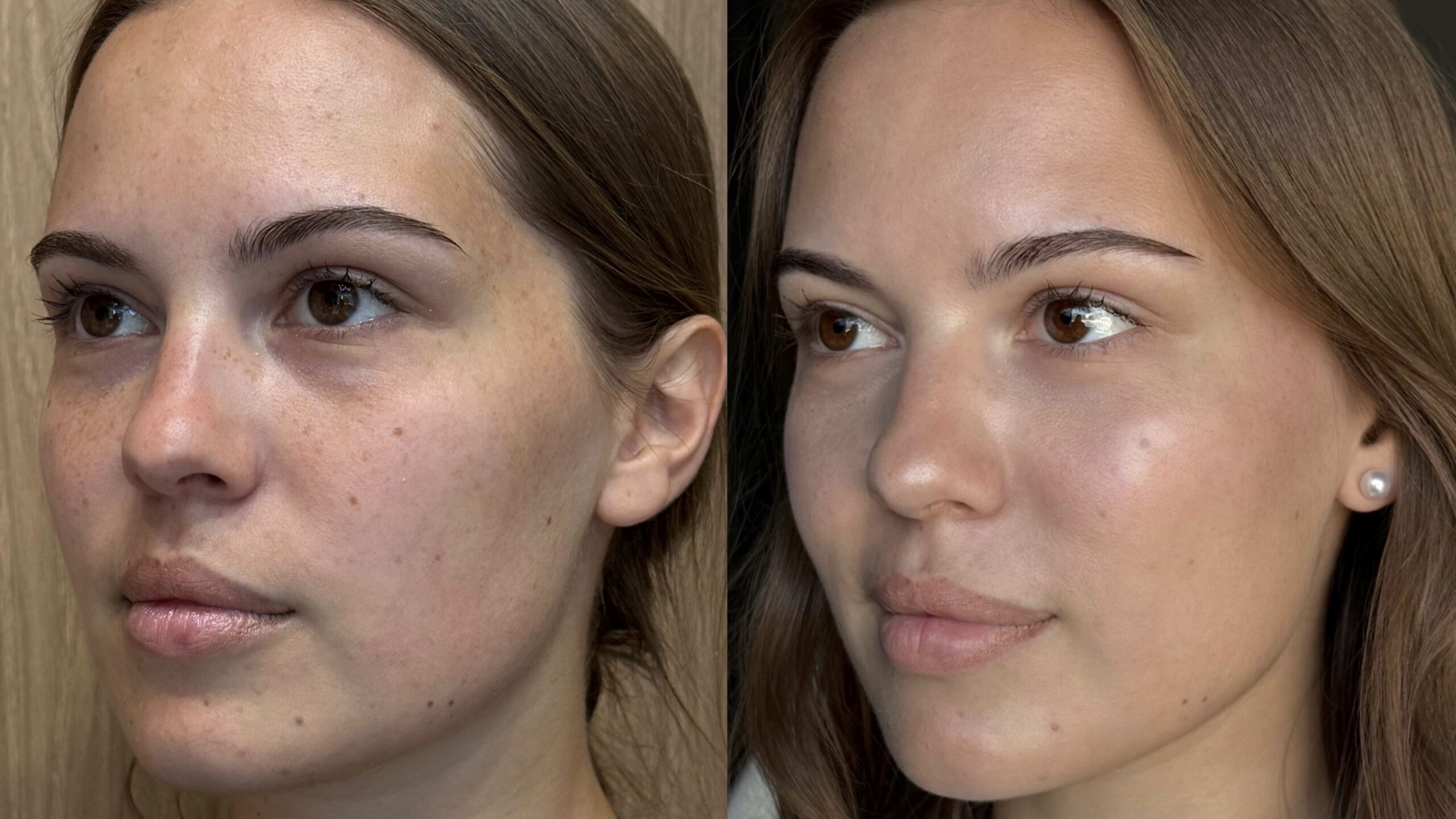 Before and after Morpheus8 RF Microneedling (Morpheus Pro) at MED YU MED Dubai: face, one month after one session
