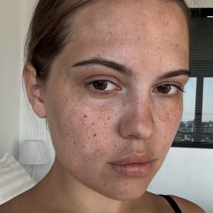 Facial Pigmentation Treatment Dubai: BBL + Biorevitalisation at MED YU MED Dubai