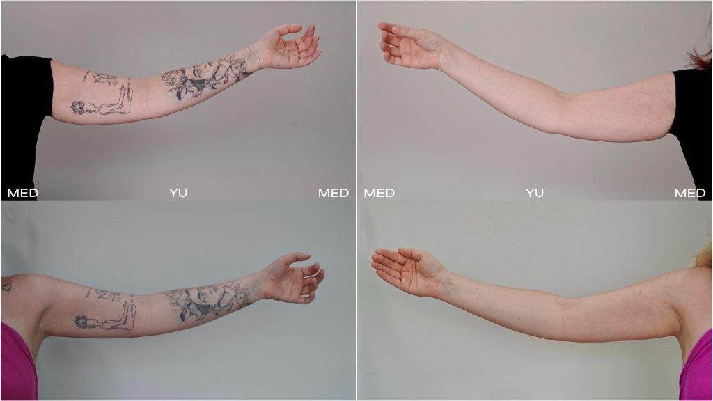 Before and after Endolift Laser Lifting at MED YU MED Dubai: forearm, skin laxity, one session