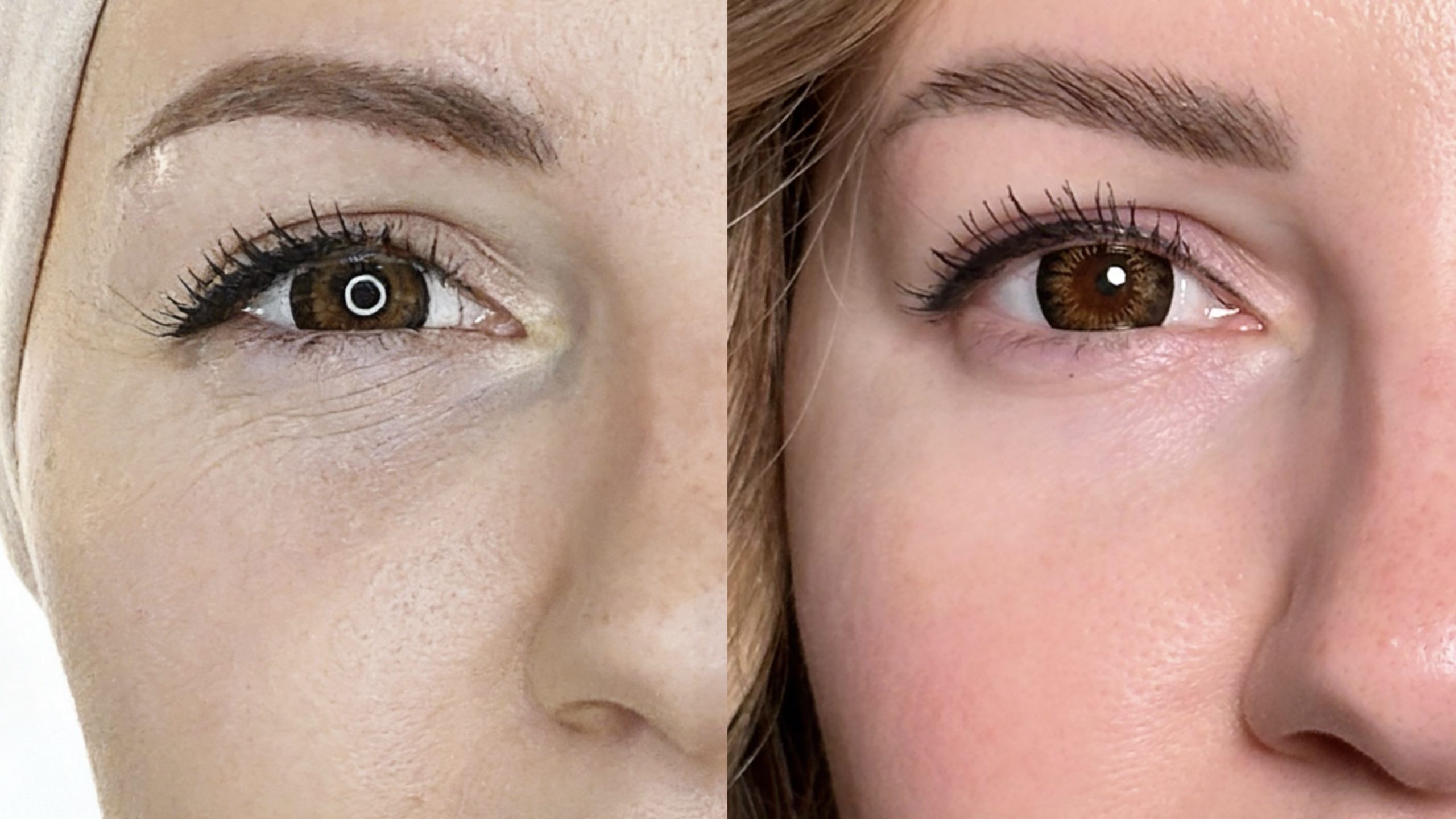 Before and after Collagen therapy at MED YU MED Dubai: eye area, one session with Juvelook