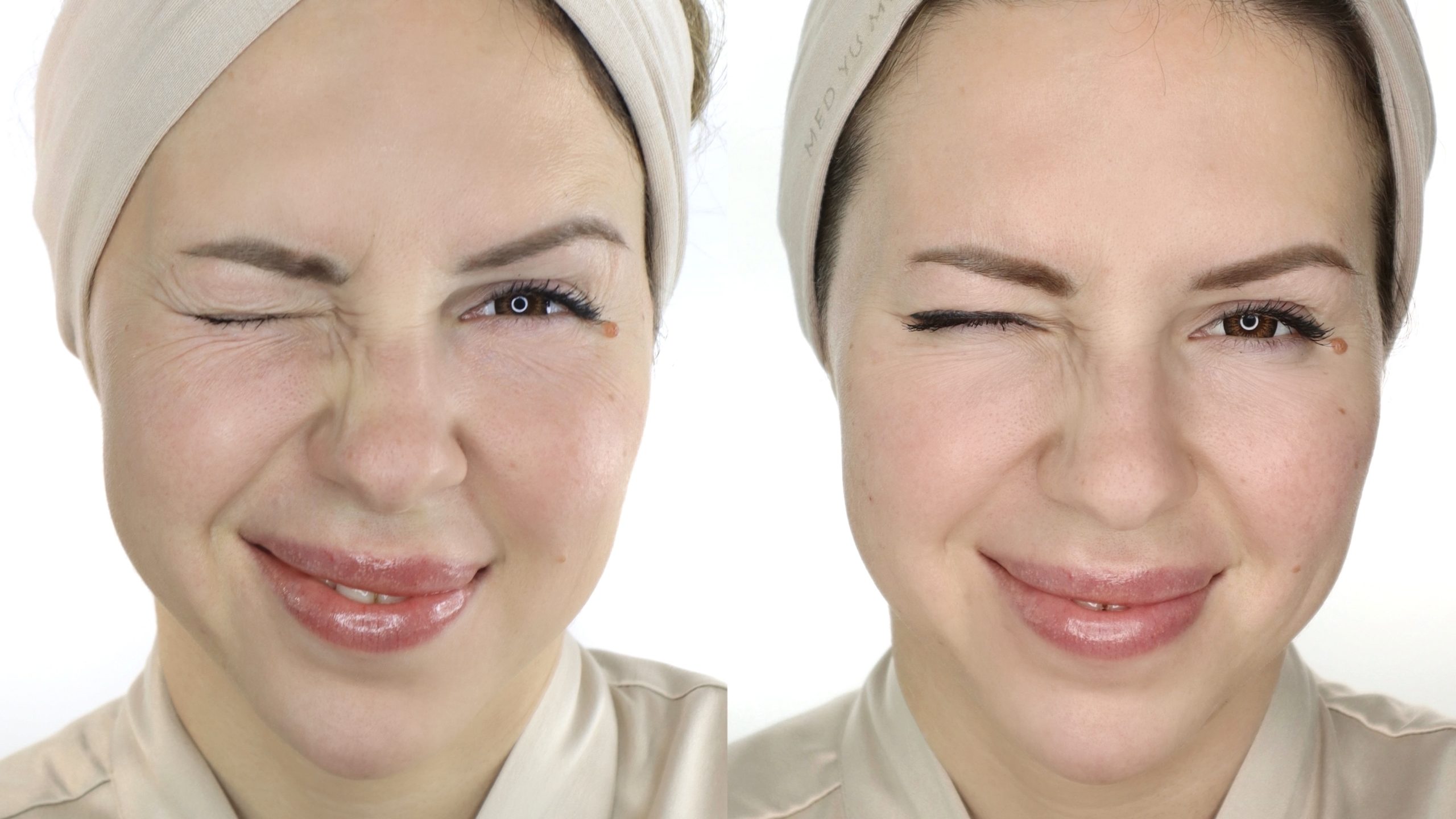 Before and after Botox (Botulinum Therapy) at MED YU MED Dubai: eye area, expression lines after one session