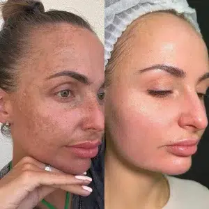 Before and after Chemical Peels at MED YU MED Dubai: face, acne and pigmentation, Me Line peel with home care and BBL