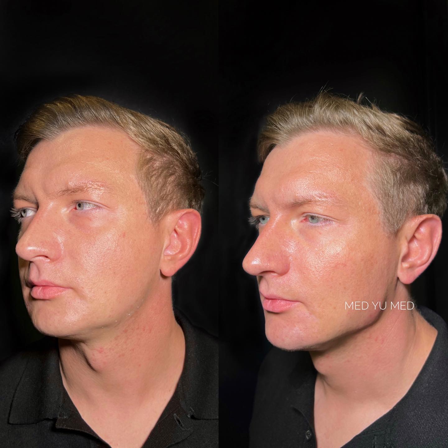 Before and after Collagen therapy at MED YU MED Dubai: face, two views, one session with Radiesse
