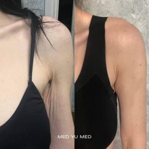 Before and after Genius RF Microneedling (Lutronic) at MED YU MED Dubai: shoulder and underarm, skin laxity