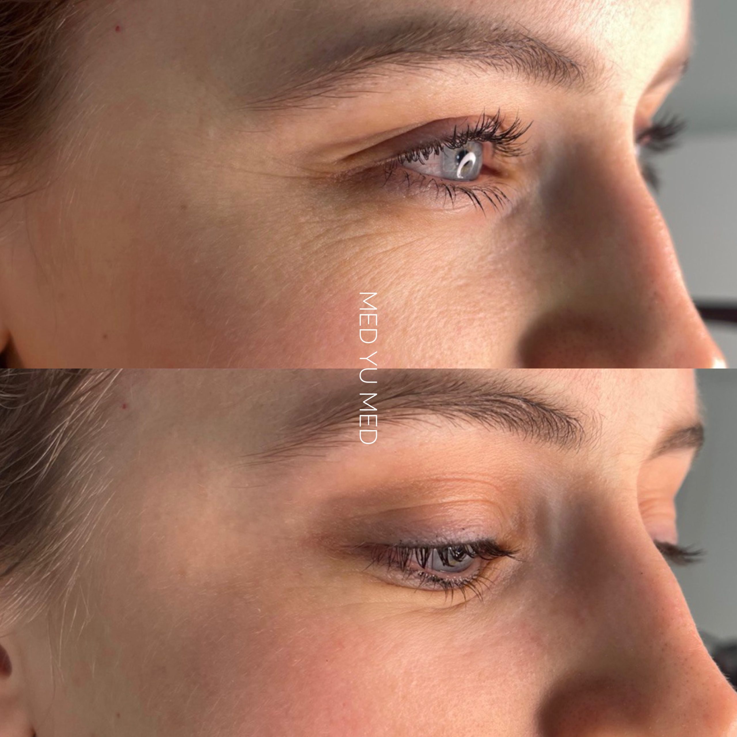 Before and after Biorevitalization at MED YU MED Dubai: eye area and eyelids, fine lines