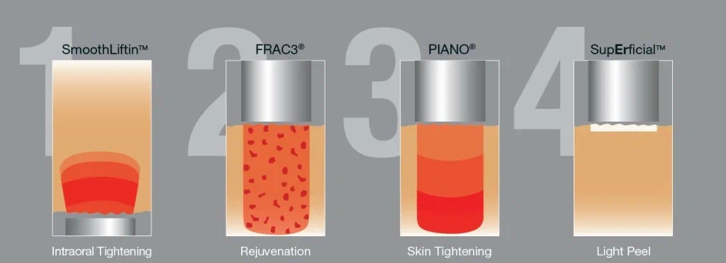 Diagram of four laser modes and the skin depth each one reaches, from intraoral tightening to a light peel