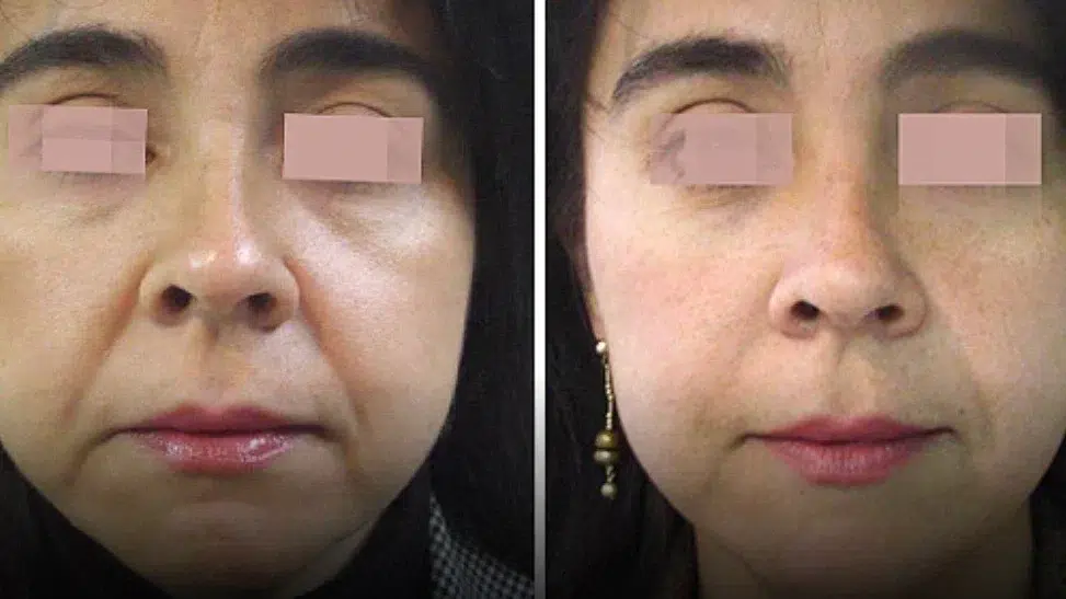 Woman's face before and after laser resurfacing, eyes covered in both frames