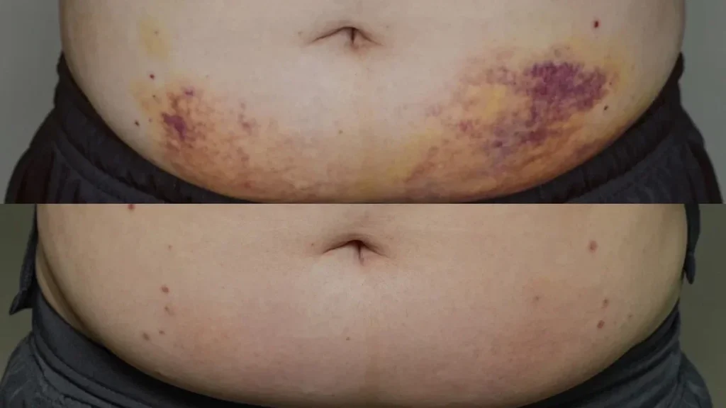 Before and after INDIBA Radiofrequency at MED YU MED Dubai: abdomen, bruising after injections, recovery support