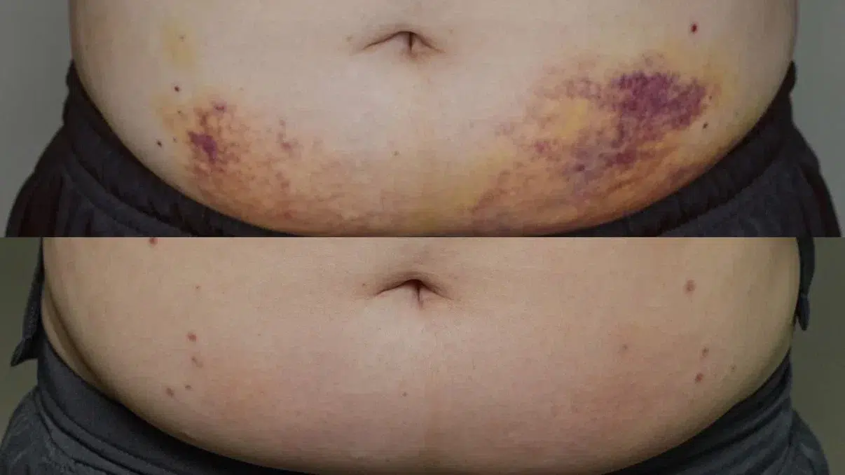 Abdomen with extensive bruising after a procedure, and the same area healed in the lower frame