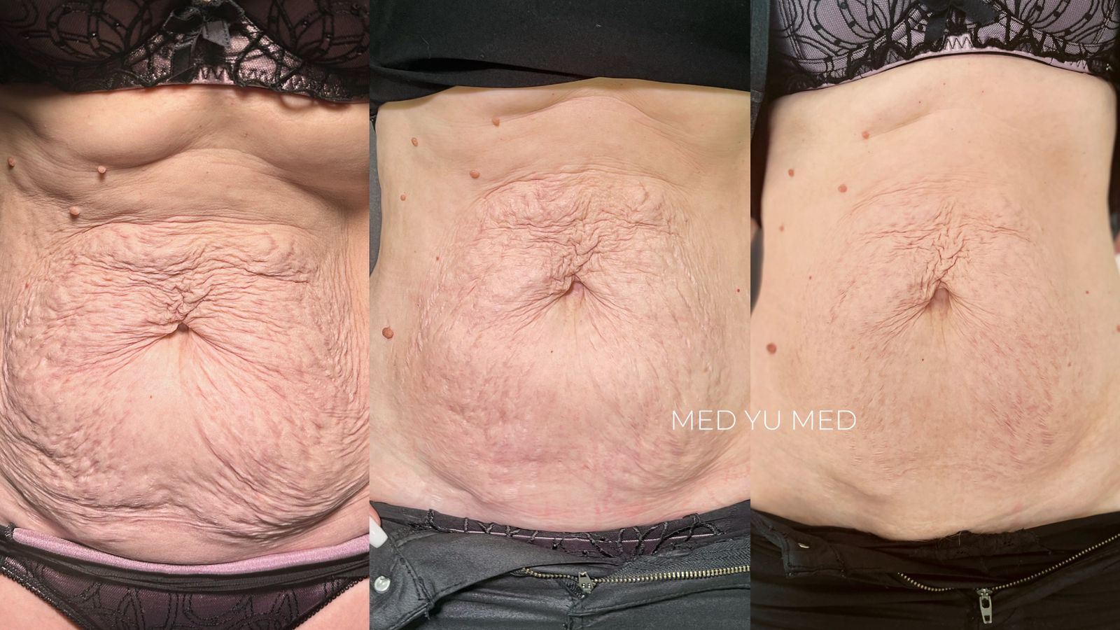 Before and after Morpheus8 RF Microneedling (Morpheus Pro) at MED YU MED Dubai: abdomen, stretch marks, combined with collagen therapy and PRP