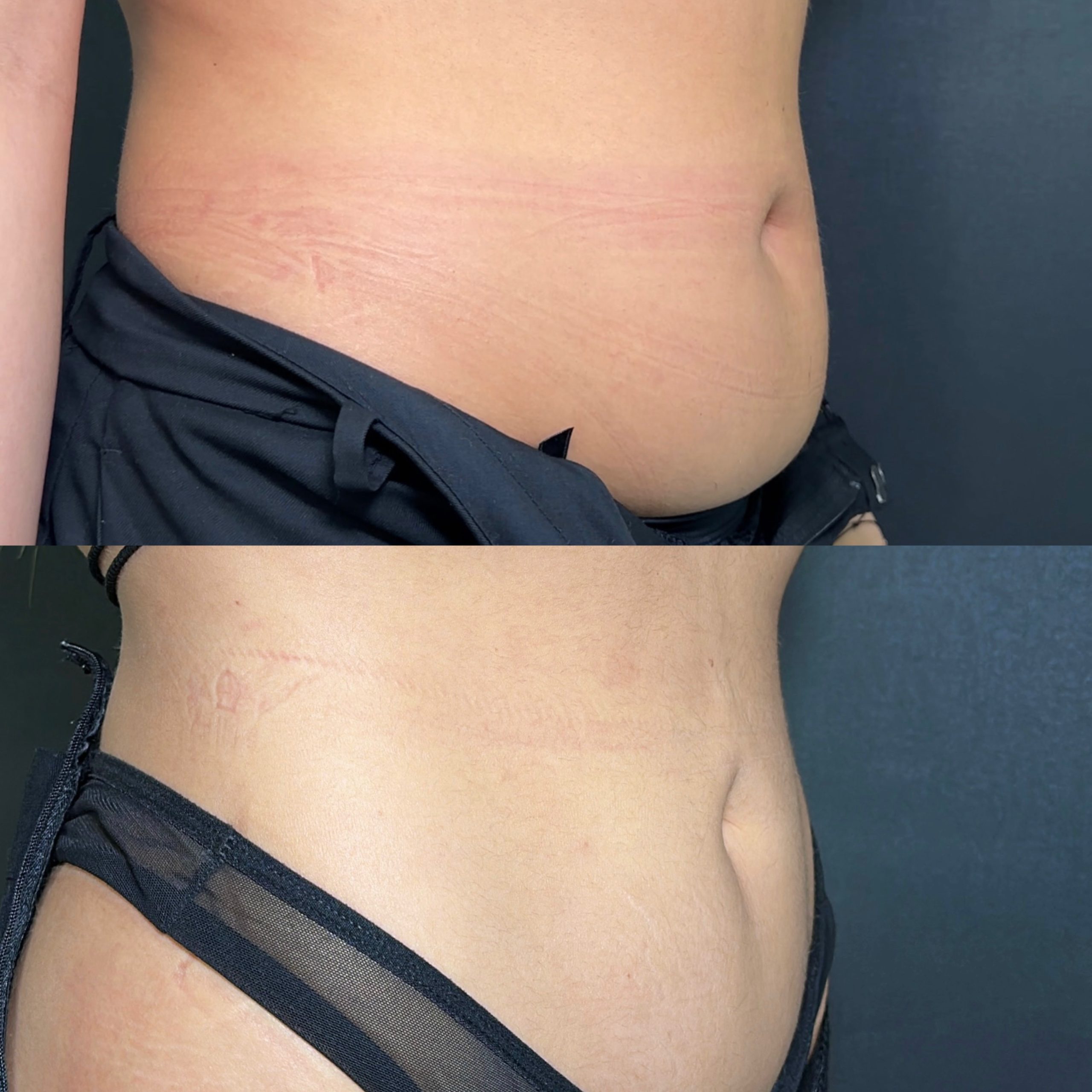 Before and after Lipolytic (Fat-Dissolving) Injections at MED YU MED Dubai: abdomen and flank, localised fat